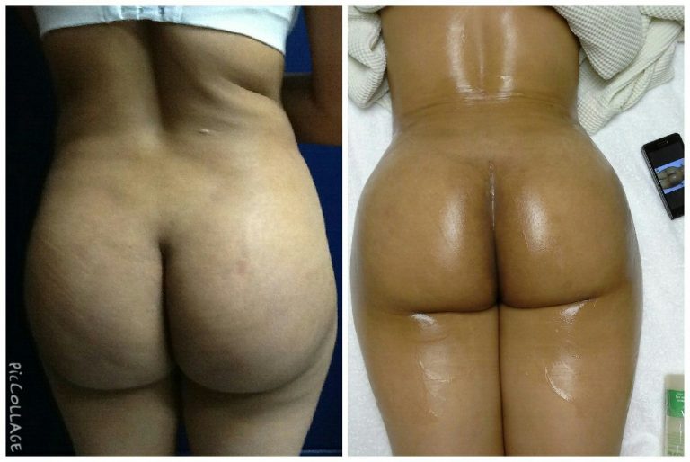 Eliminacion Biopolimeros Pic 3
